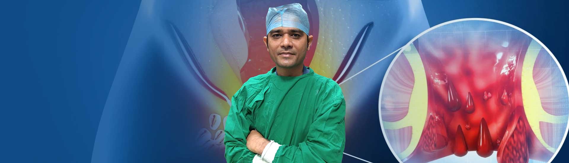 Piles Stages in Male and Female