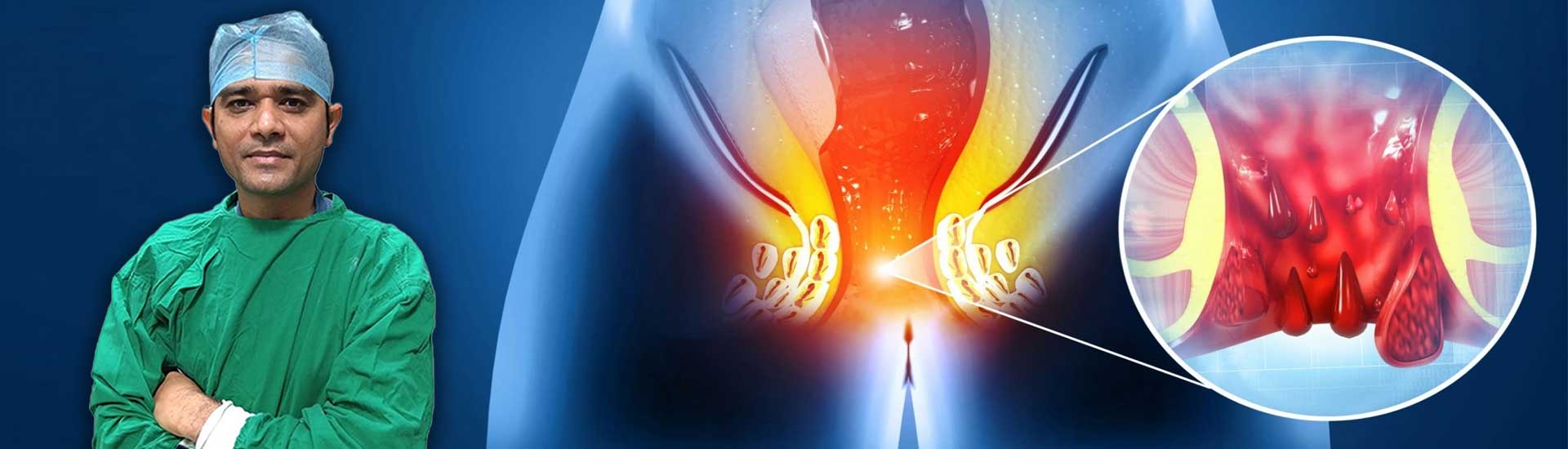 Laser treatment for fistula success rate