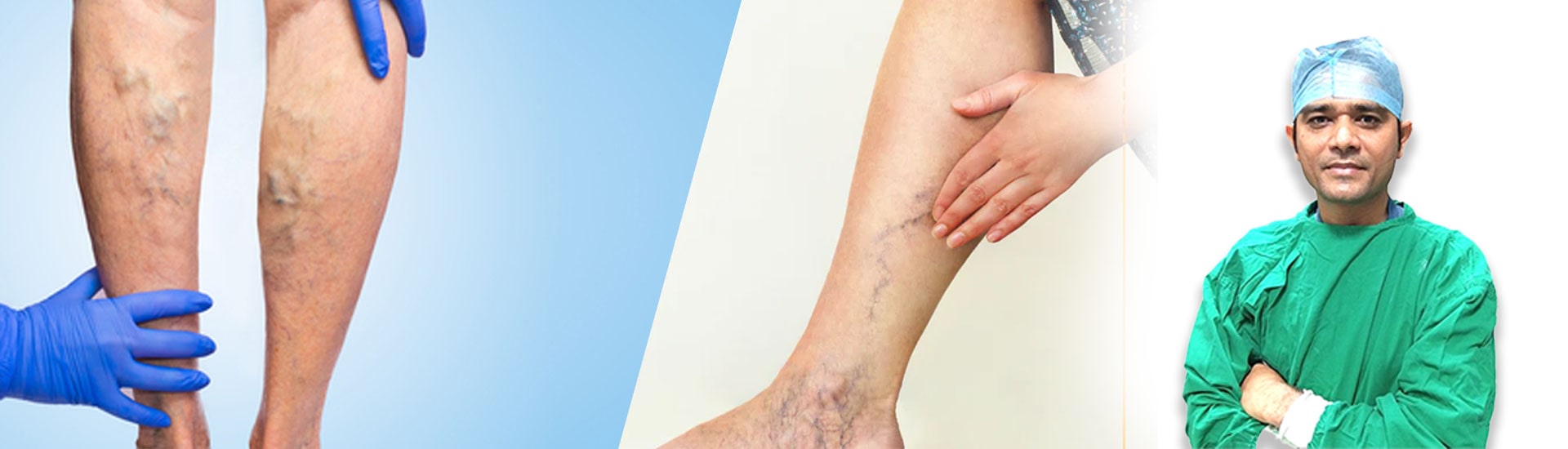 6 Stages of Varicose Veins